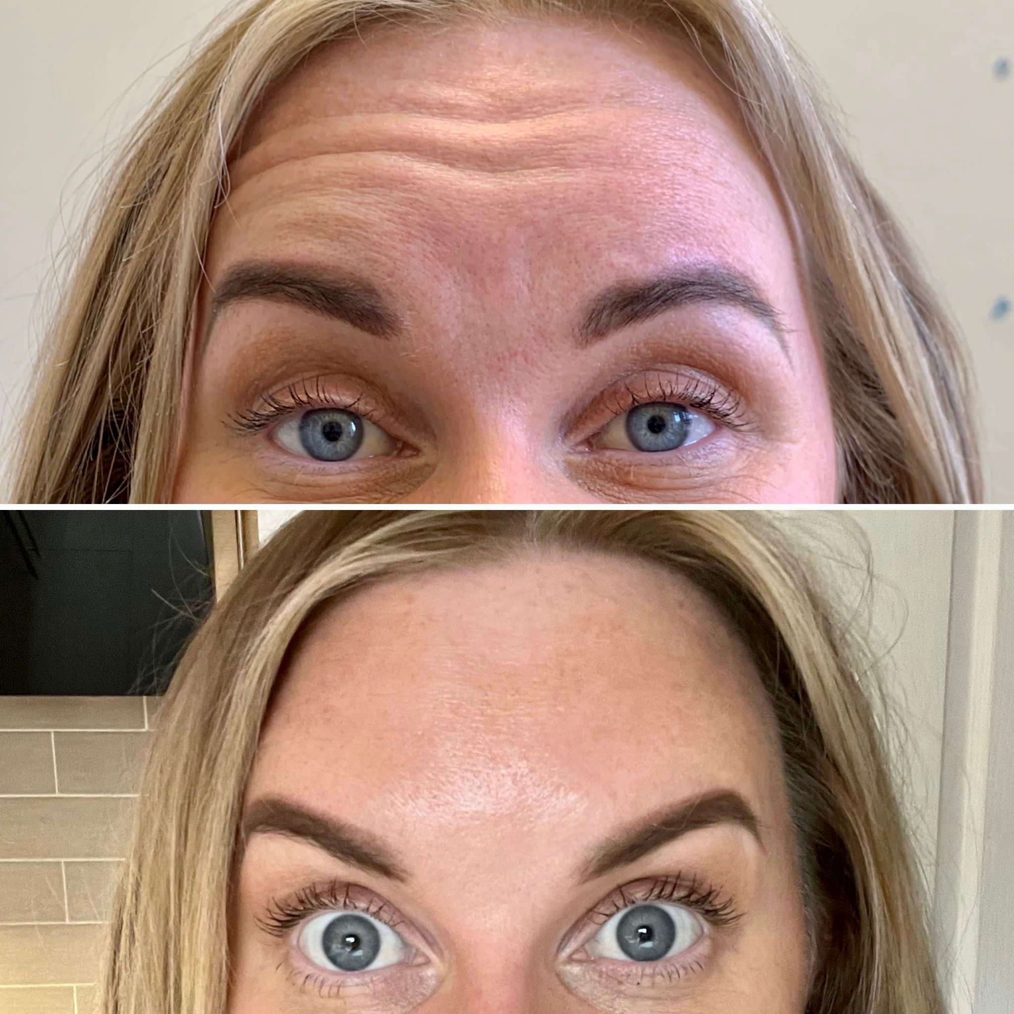 Anti Wrinkle Injection Training Courses For Medical Professionals & Non Medics - Image 7