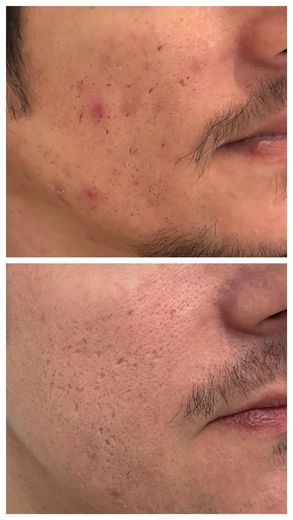ORIGIN Erbium Glass acne scarring case photo 1, Valessa Aesthetics Institute Liverpool
