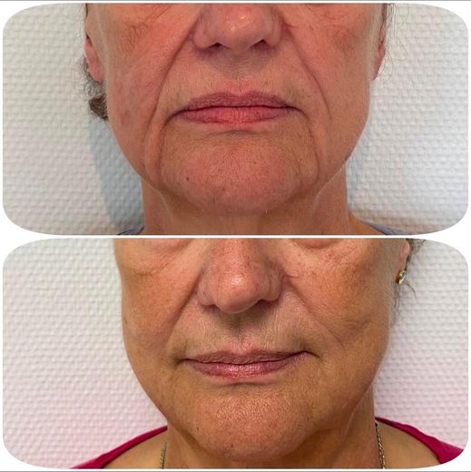 ORIGIN Erbium Glass fine lines and wrinkles case photo 1, Valessa Aesthetics Institute Liverpool