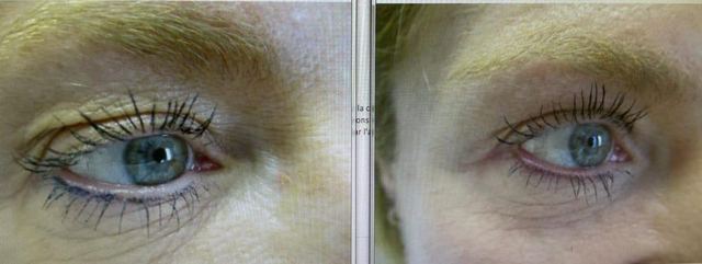 ORIGIN Erbium Glass fine lines and wrinkles case photo 2, Valessa Aesthetics Institute Liverpool