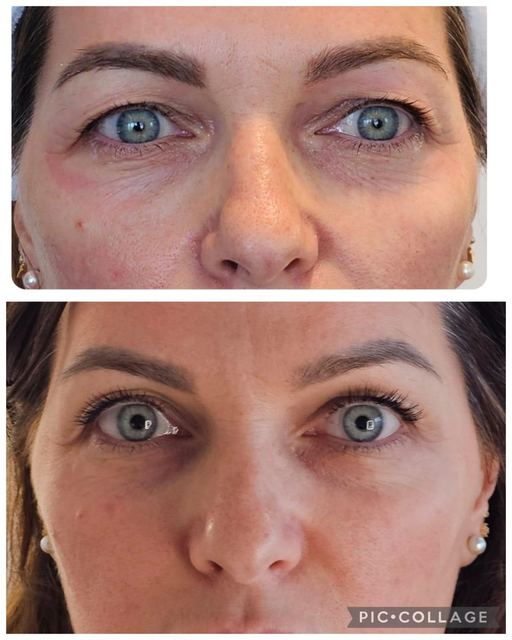 ORIGIN Erbium Glass fine lines and wrinkles case photo 6, Valessa Aesthetics Institute Liverpool