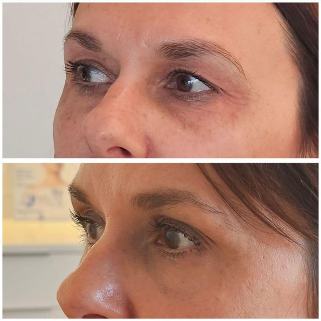 ORIGIN Erbium Glass fine lines and wrinkles case photo 7, Valessa Aesthetics Institute Liverpool