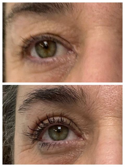 ORIGIN Erbium Glass fine lines and wrinkles case photo 9, Valessa Aesthetics Institute Liverpool