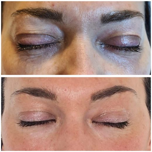 ORIGIN Erbium Glass periorbital pigmentation case photo 1, Valessa Aesthetics Institute Liverpool