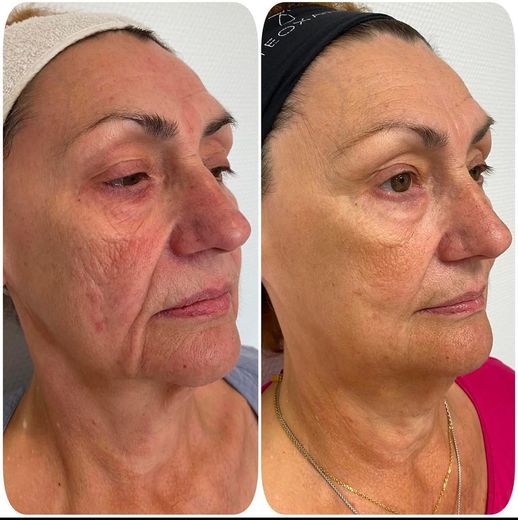 ORIGIN Erbium Glass full face skin rejuvenation case photo 1, Valessa Aesthetics Institute Liverpool