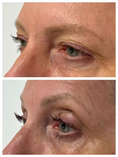ORIGIN Erbium Glass upper eyelid skin tightening case photo 1, Valessa Aesthetics Institute Liverpool