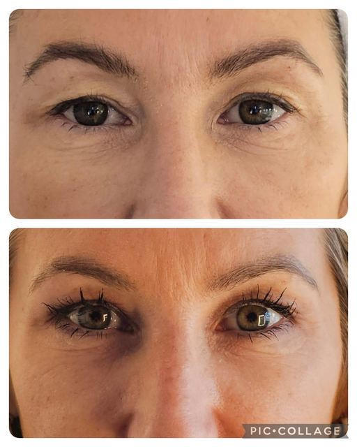ORIGIN Erbium Glass upper eyelid skin tightening case photo 3, Valessa Aesthetics Institute Liverpool