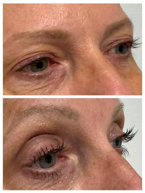 ORIGIN Erbium Glass upper eyelid skin tightening case photo 5, Valessa Aesthetics Institute Liverpool
