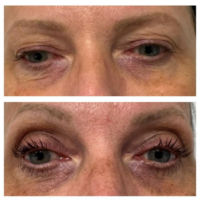 ORIGIN Erbium Glass upper eyelid skin tightening case photo 6, Valessa Aesthetics Institute Liverpool