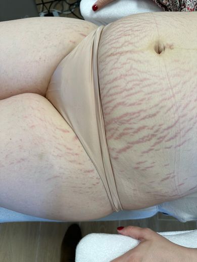 ORIGIN Erbium Glass stretch marks case photo 1, Valessa Aesthetics Institute Liverpool
